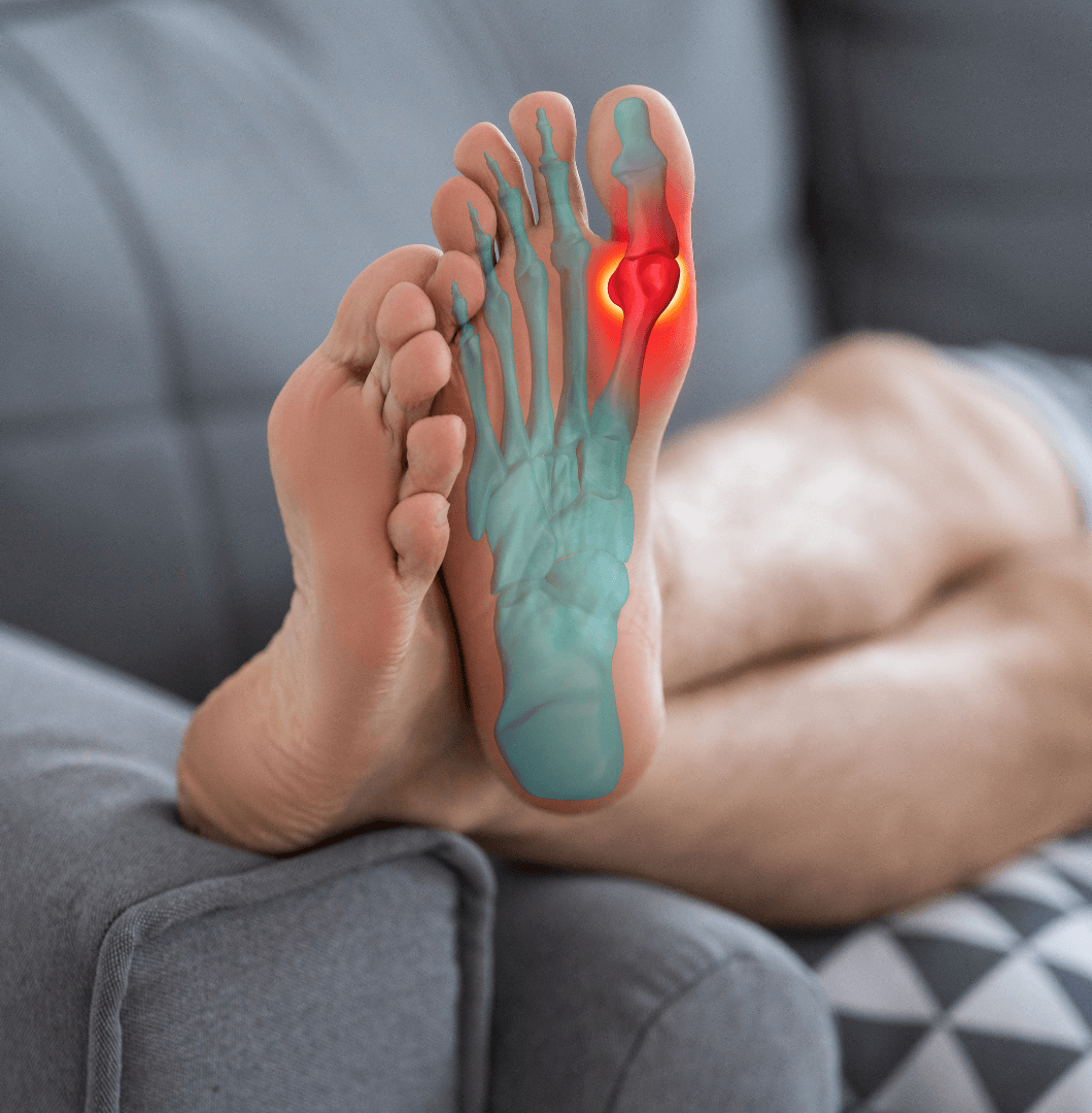 Hallux Valgus Symptome Schmerzen