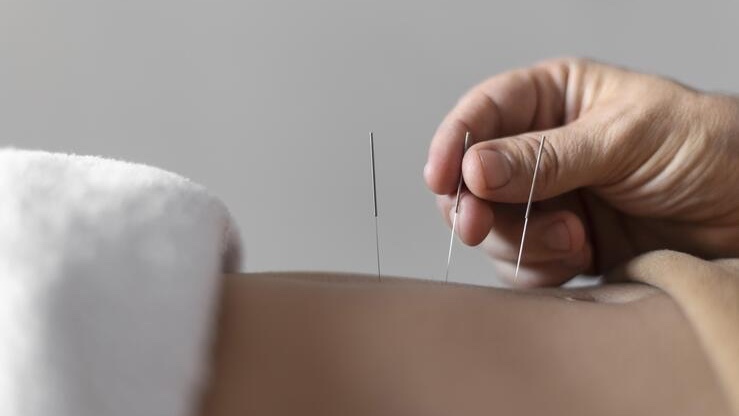 Akupunktur gegen Allergien MVZ Kaiser