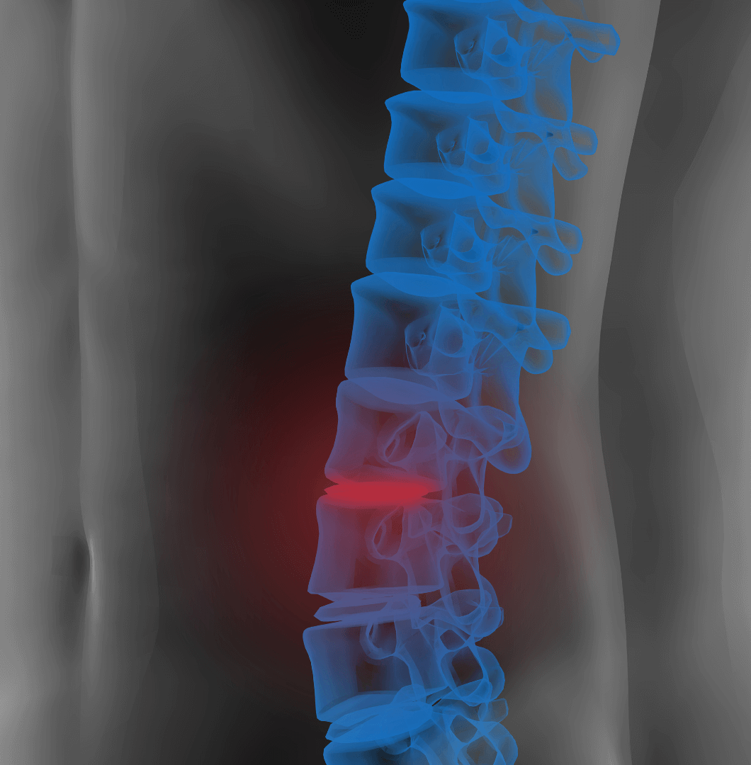 Ursachen Spondylolisthesis
