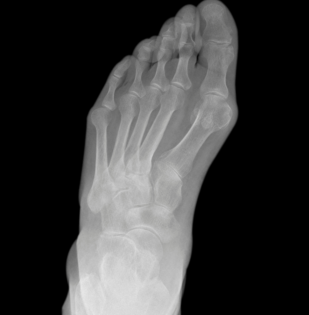 Diagnose Hallux Valgus