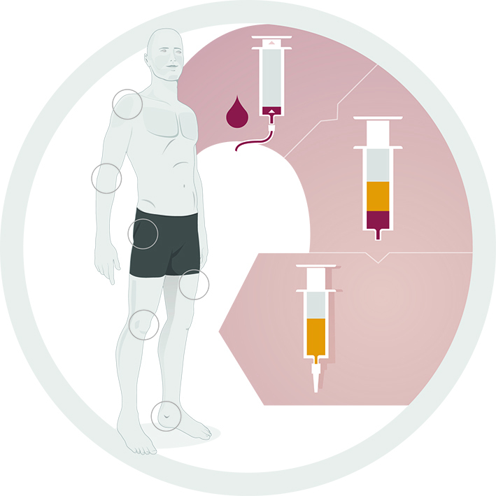 ACP-Therapie Anwendungsbereiche 